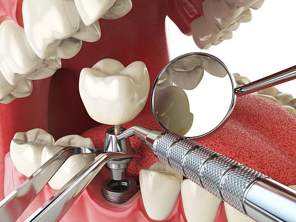 Best Urgent Care for Lost Fillings or Crowns in Yucos, CA